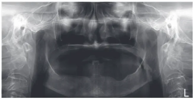 Fig. 1. Initial panoramic view. Fig. 2. Initial intraoral view. (A) Maxilla, (B) Mandible.