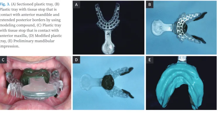 Fig. 3. (A) Sectioned plastic tray, (B)  Plastic tray with tissue stop that is  contact with anterior mandible and  extended posterior borders by using  modeling compound, (C) Plastic tray  with tissue stop that is contact with  anterior maxilla, (D) Modif