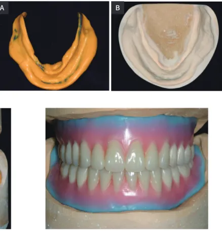 Fig. 6. (A) Definitive mandibular impression, 