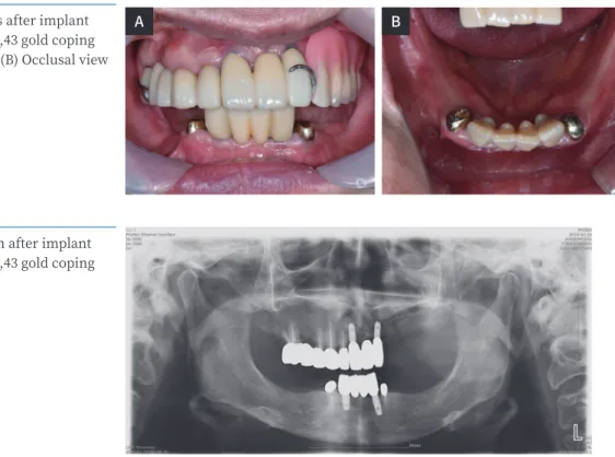 Fig. 3. Panoramic radiograph after implant  surveyed prostheses and #33,43 gold coping  placement.
