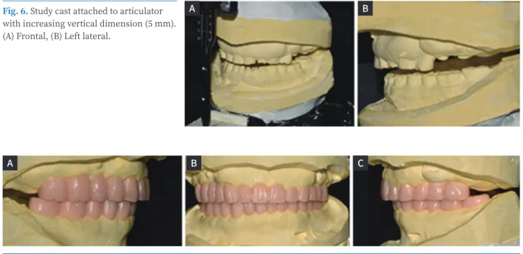 Fig. 7. Diagnostic wax-up. (A) Right lateral, (B) Frontal, (C) Left lateral.