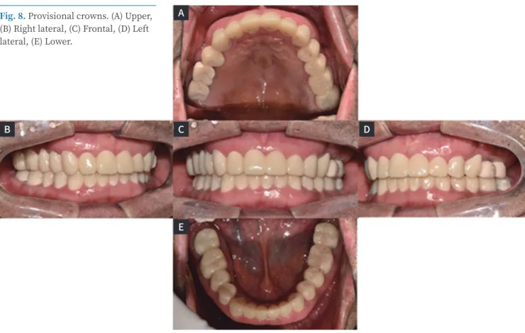 Fig. 8. Provisional crowns. (A) Upper,  (B) Right lateral, (C) Frontal, (D) Left  lateral, (E) Lower.