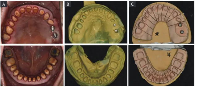 Fig. 10. Design of definitive prostheses using double scanning procedure. (A) Upper, (B) Frontal, (C) Lower.