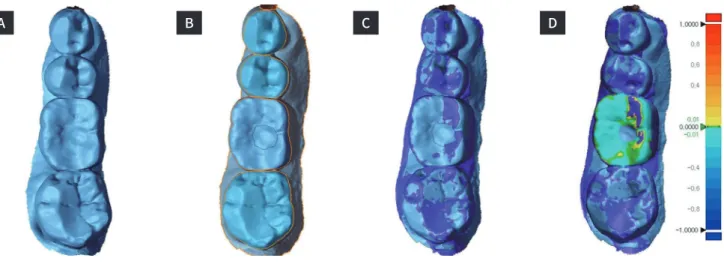 Fig. 6. 3-dimensional examination of #36 (A) Intraoral scanned file (B) Setting #34, #35, and #37 as the area of interest (C) Best-fit  alignment using the area of interest (D) 3-dimensional comparison demonstrating infraposition of #36 in relation to the 