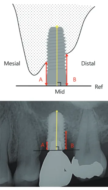 Fig. 2. Radiographic measurement &amp; schematic drawing of  assessment of crestal bone level