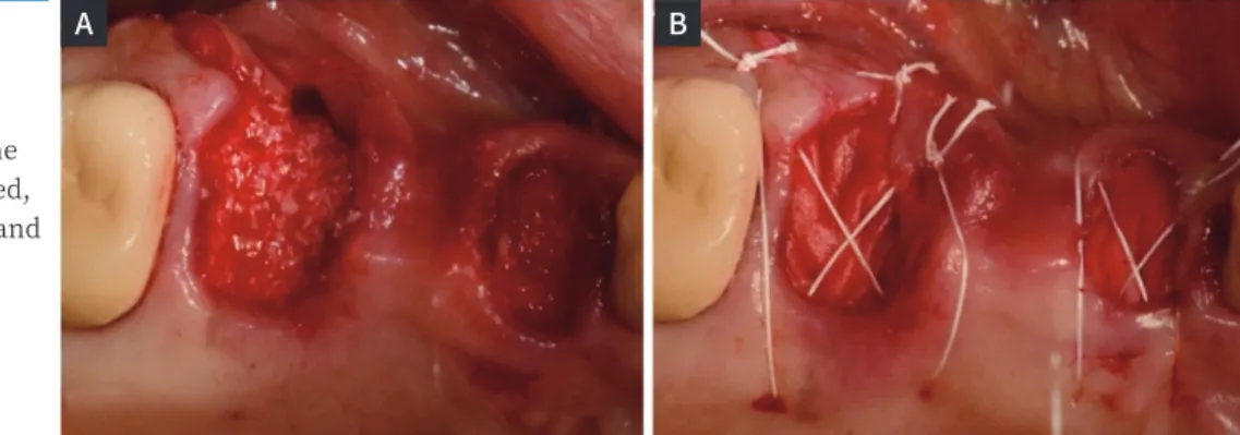 Fig. 3. Surgical technique. 