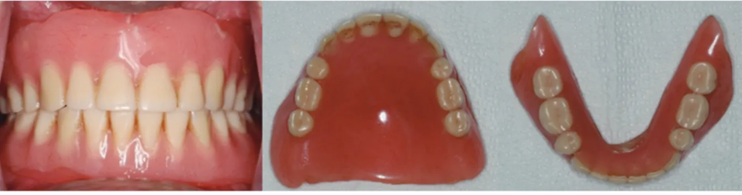 Fig. 3. (A) Centric tray, (B) Plastic  ready-made trays and preliminary  impression materials.