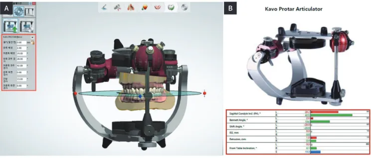 Fig. 9. Inserting individualized setting value to virtual articulator. (A) Virtual articulator, (B) JMA articulating report.