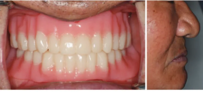 Fig. 11. Conventional complete denture and it’s lip support.