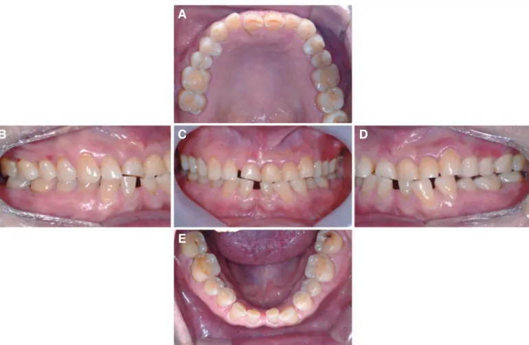 Fig. 1. Intraoral status in the initial examination. (A) Maxillary occlusal view, (B) Right lateral view, (C) Frontal view at maximal intercuspal position, (D) Left  lateral view, (E) Mandibular occlusal view