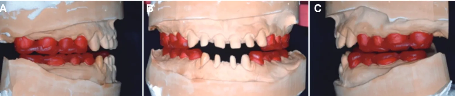 Fig. 6. Fabrication of repositioning jig. (A) Right lateral view, (B) Frontal view, (C) Left lateral view.