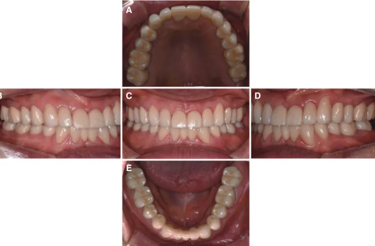 Fig. 10. Definitive prosthesis. (A) Maxillary occlusal view, (B) Right lateral view, (C) Frontal view at maximal intercuspal position, (D) Left lateral view, (E)  Mandibular occlusal view.
