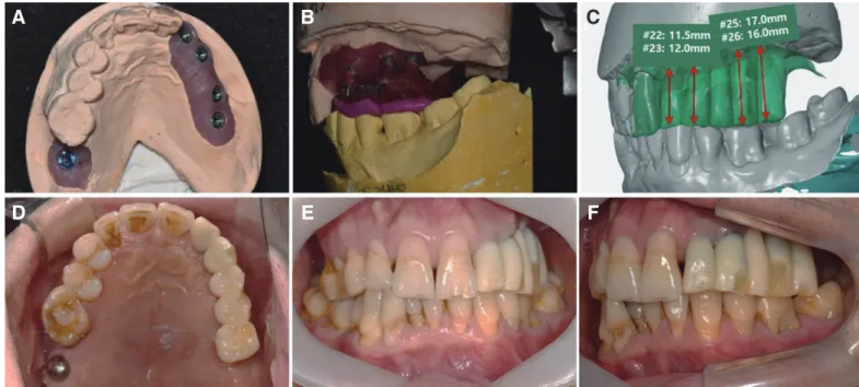 Fig. 3. Fabrication for temporary fixed prosthesis. (A) Master cast, (B) Bite registration, (C) Predicted crown height space, Intraoral view after temporary fixed  prosthesis try in, (D) Occlusal view of maxilla, (E) Frontal view, (F) Left view