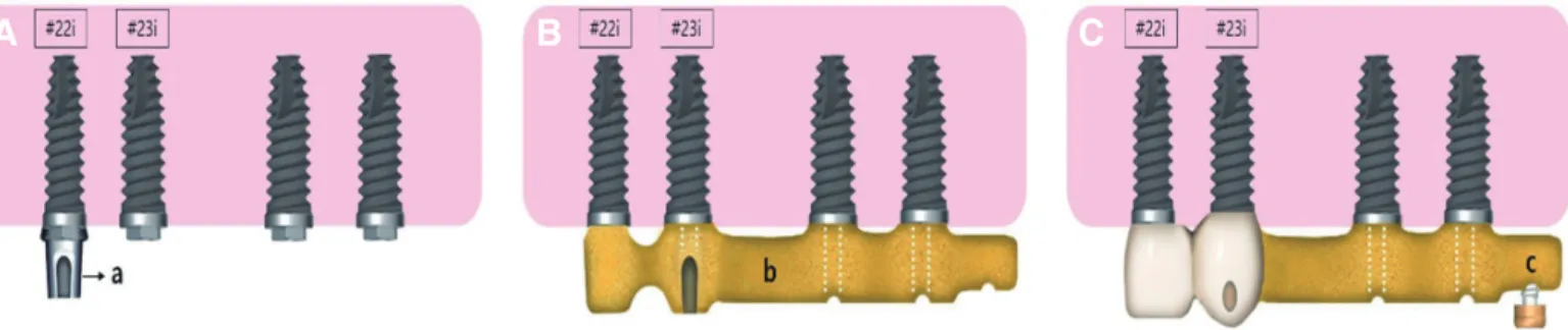 Fig. 6. Illustration of milled bar fabrication. (A) #22i customized titanium abutment, (B) Cementation of milled bar and #22i customized titanium abutment, (C)  Cementation of milled bar and #22=23 splinted crowns; a
