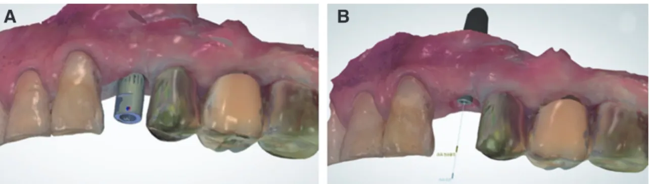 Fig. 2. (A) Digital impression coping and adjacent teeth scanned using intraoral scanner, (B) Digital impression coping can be  matched with correct implant analog using CAD software.