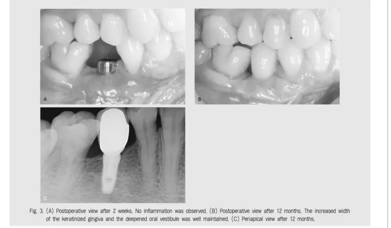 Fig. 3. (A) Postoperative view after 2 weeks. No inflammation was observed. (B) Postoperative view after 12 months