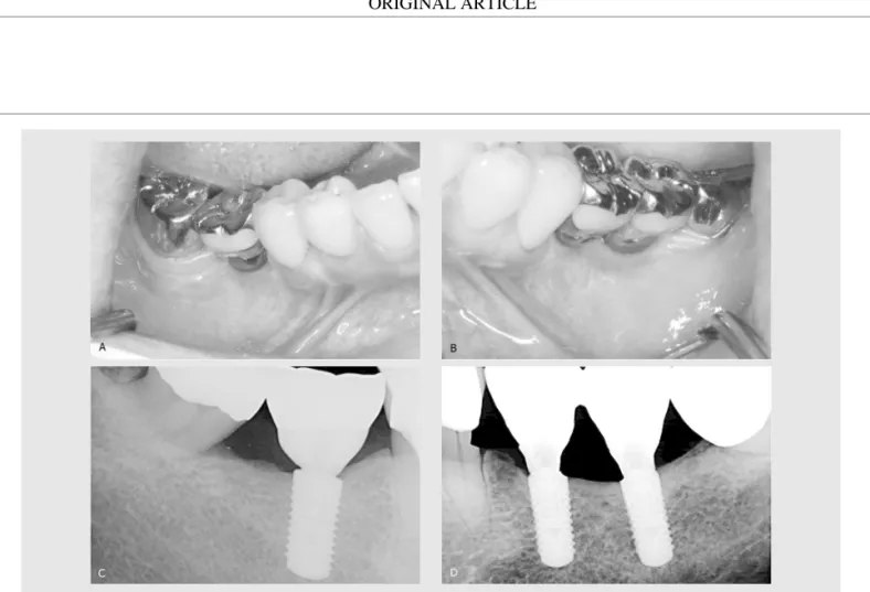 Fig. 6. (A, B) Postoperative view of both sides after 12 months. The increased width of the keratinized gingiva and the deepened oral vestibule was well maintained