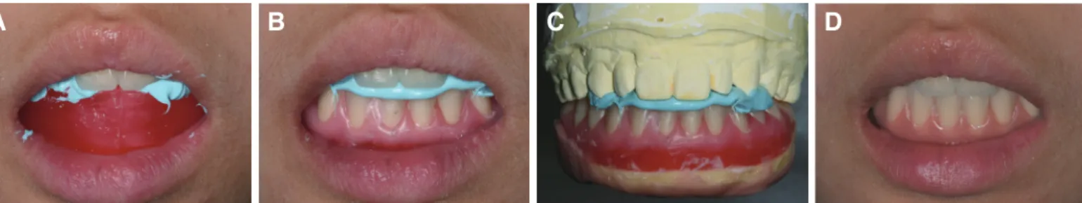 Fig. 3. Cone beam CT images for implants planning. (A)  Mandibular right first premolar, (B) Mandibular right  canine, (C) Mandibular left canine, (D) Mandibular left  first premolar.