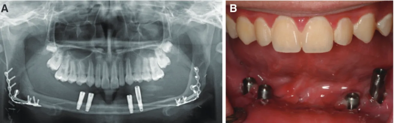 Fig. 4. (A) Panoramic radiograph after implants placement, (B) Intraoral photograph after implants placement.