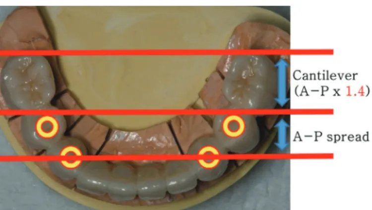 Fig. 10. Definitive prostheses showing proper cantilever. 해서도  영향을 받는데, 본 환자에서 이상 기능은 발견되지 않았 으며, 교합력은 약한 편으로 이러한 요소에 의한 문제는 크지 않 을 것으로 판단된다