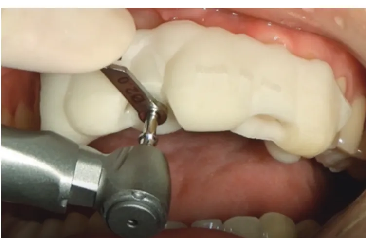 Fig. 3. 2.0-mm-diameter drill for placing a narrow implant. Fig. 4. Provisional prosthesis