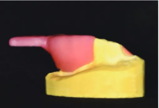 Fig. 5. Impression taking.