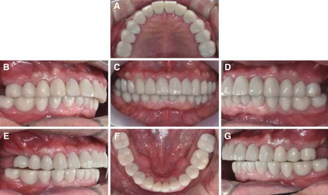 Fig. 8. Definitive impression and master cast. (A, B) Impression, (C, D) Master Cast, (E) Master cast cross mounted.