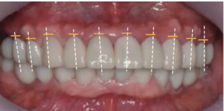 Fig. 12. Extra oral photographs &amp; panoramic radiograph after treatment. (A)  Frontal (rest), (B) Frontal (smile), (C) Lateral (rest), (D) Panoramic  radio-graph.