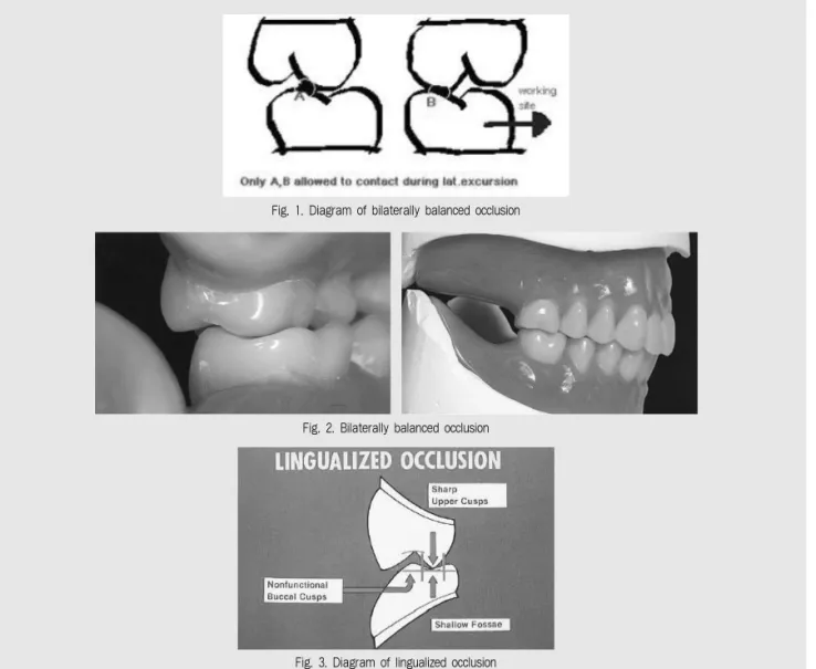 Fig. 2. Bilaterally balanced occlusion