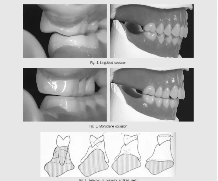 Fig. 4. Lingulized occlusion