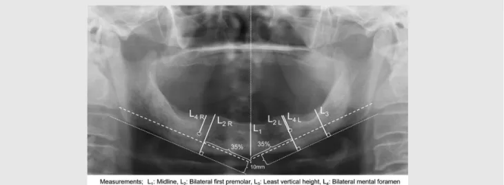 Fig. 7. Reference lines and measured heights in edentulous arches 7