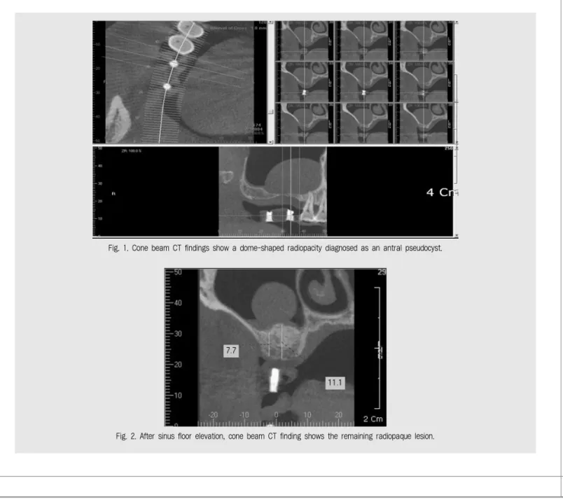 Fig. 2. After sinus floor elevation, cone beam CT finding shows the remaining radiopaque lesion