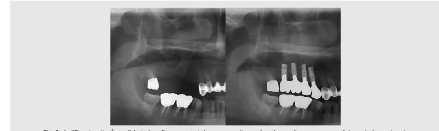 Fig. 3. A different patient’s radiological profile comparing the pre-operation and post-operation appearance of the antral pseudocyst.