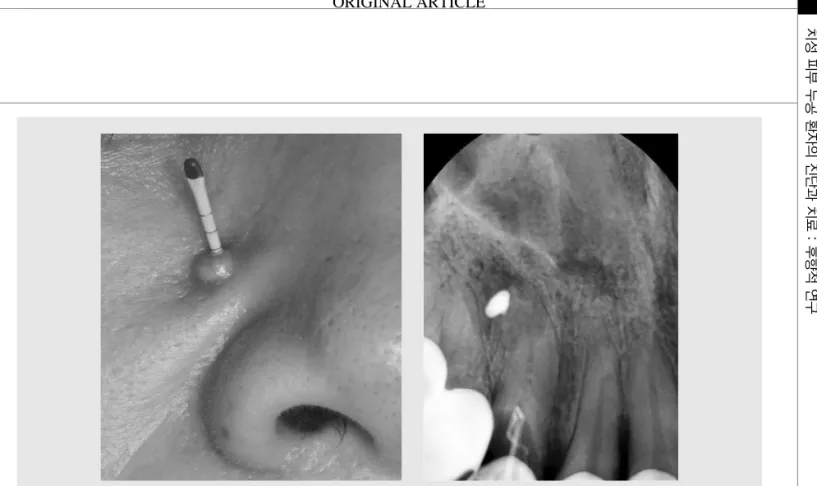Fig. 2. Cutaneous sinus tract was traced by GP cone tracing Fig. 3. Periapical x-ray view of GP cone tracing