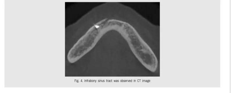 Fig. 4. Infrabony sinus tract was observed in CT image