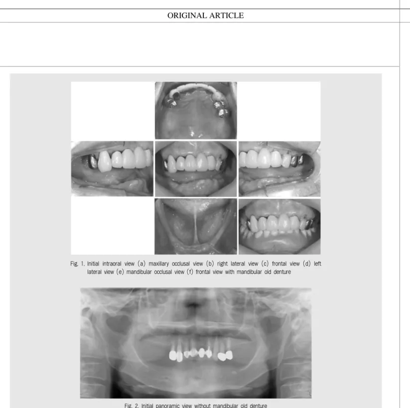 Fig. 1. Initial intraoral view (a) maxillary occlusal view (b) right lateral view (c) frontal view (d) left lateral view (e) mandibular occlusal view (f) frontal view with mandibular old denture
