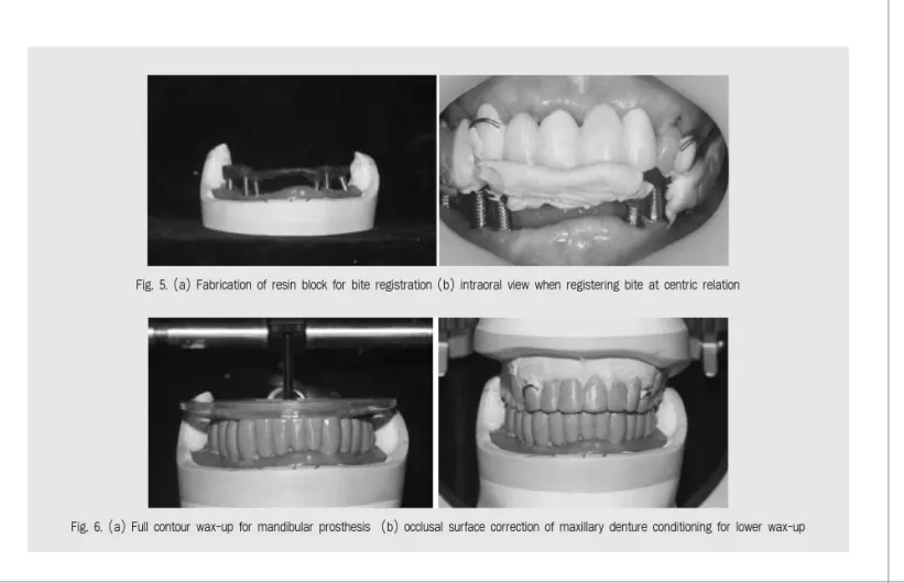 Fig. 6. (a) Full contour wax-up for mandibular prosthesis  (b) occlusal surface correction of maxillary denture conditioning for lower wax-up