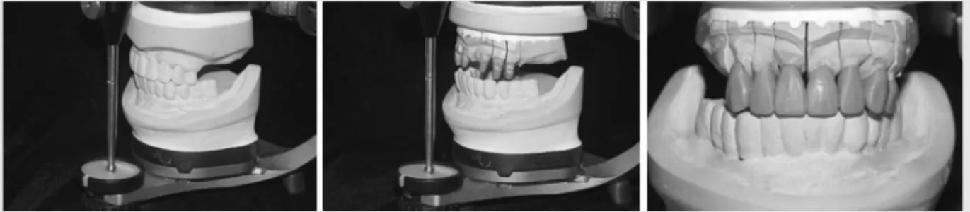 Fig. 9. Intraoral view after adaptation of maxillary surveyed crowns (a) frontal view (b) maxillary occlusal view