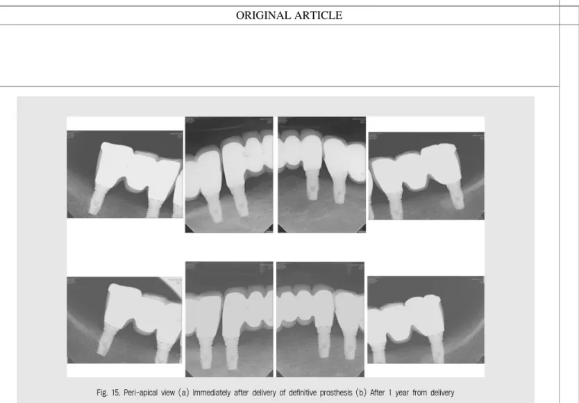 Fig. 15. Peri-apical view (a) Immediately after delivery of definitive prosthesis (b) After 1 year from delivery
