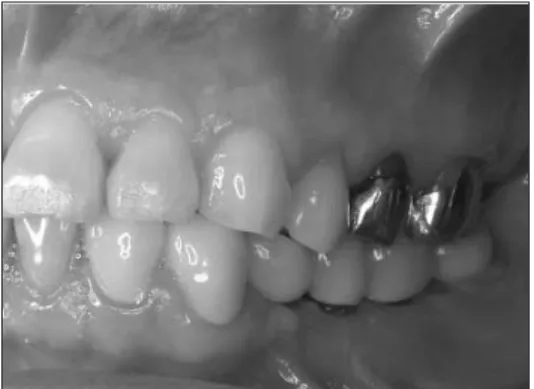Fig.  13.  Panoramic  radiograph  4  months  post- post-operatively.