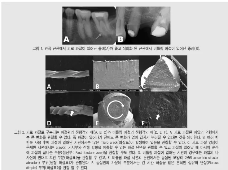그림 1. 만곡 근관에서 피로 파절이 일어난 증례(A)와 좁고 석회화 된 근관에서 비틀림 파절이 일어난 증례(B).