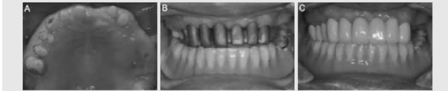 Fig. 7. Denture framework try-in and Jaw relation registration.