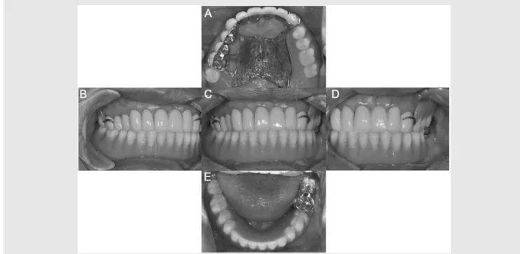 Fig. 9. Blue nylon male inserted after 4 weeks