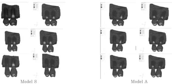 Fig. 4. Buccal view of stress contour on Model S and A under Load condition 1: non-splinted and splinted situations(left to right) ; C/R ratios are  0.7:1, 1:1 and  1.25:1(top to bottom).