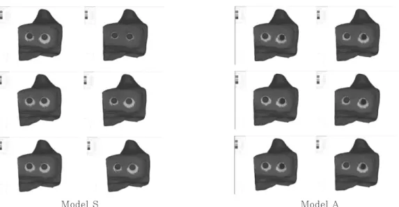 Fig. 9. Cervical sectional view of stress contour on Model S and A under Load condition 3: non- non-splinted and non-splinted situations(left to right) ; C/R ratio 0.7:1, 1:1 and 1.25:1(top to bottom).