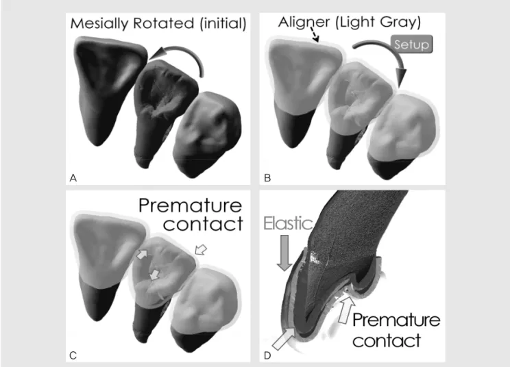 Fig. 16. Illustration of incomplete tooth capture in rotation control. A, Maxillary left lateral incisor was rotated mesially