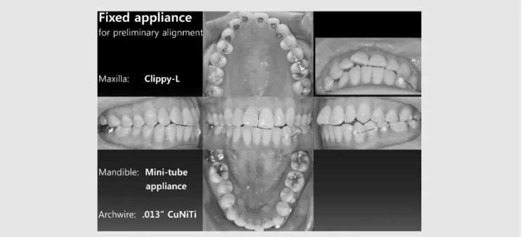 Fig. 10. Preliminary alignment was completed and composite attachments were bonded. Debonding and interproximal reproximation were done before impression taking for fabrication of clear aligners.