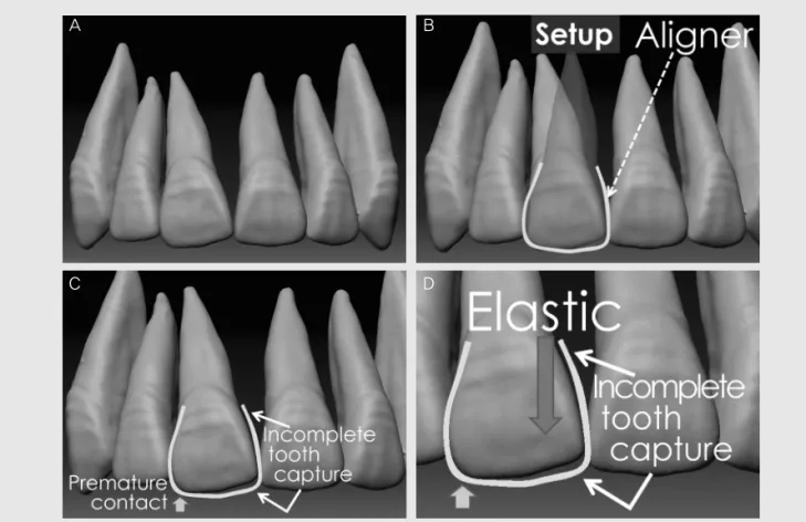 Fig. 15. Illustration of incomplete tooth capture in tipping control. A, Maxillary right central incisor was tipped mesially