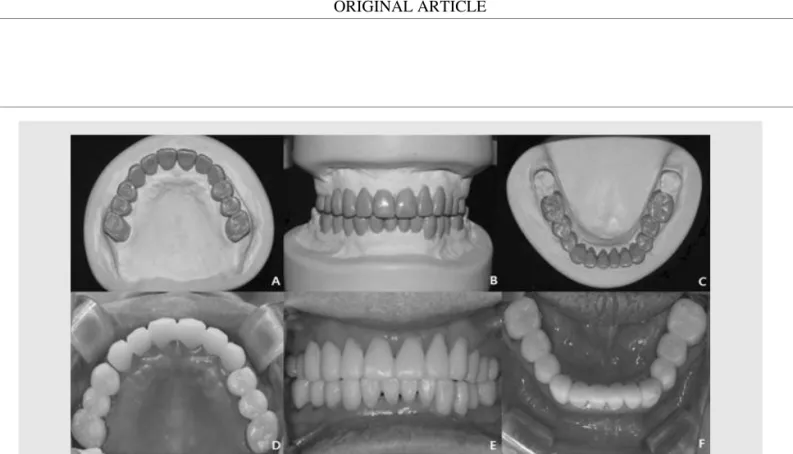 Fig. 3. Diagnostic  wax  up  (A,  B,  C)  and  temporary  prostheses  (D,  E,  F).  A,  D:  Maxillary  occlusal  view,  B,  E:  Frontal  view,  C,  F: