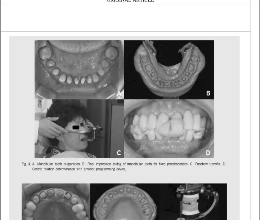 Fig. 4. A: Mandibular teeth preparation, B: Final impression taking of mandibular teeth for fixed prosthodontics, C: Facebow transfer, D: